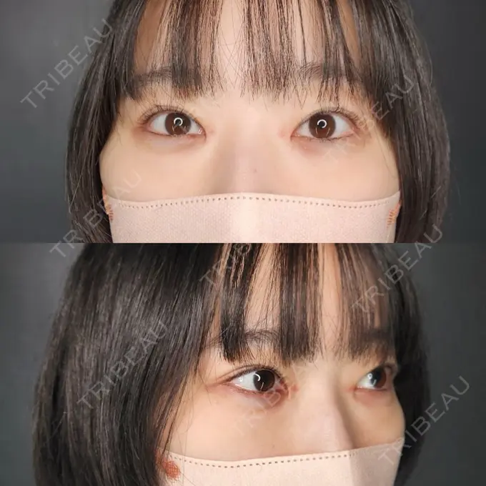 クマ治療 / ヒアルロン酸注入（目の下） / スネコス Tokyo Tensei Clinic 新宿院 BEFORE メイン用