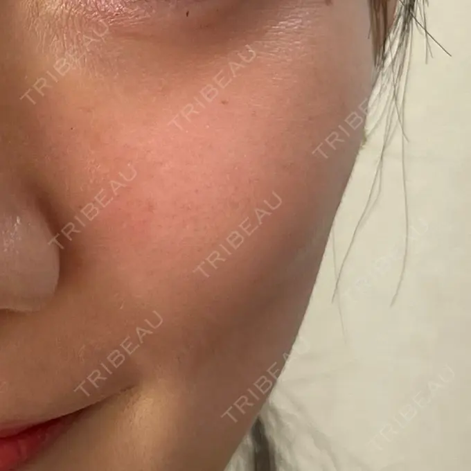 ボトックス（眉間） / ボトックス（目尻） TCB東京中央美容外科 新宿三丁目院 BEFORE メイン用