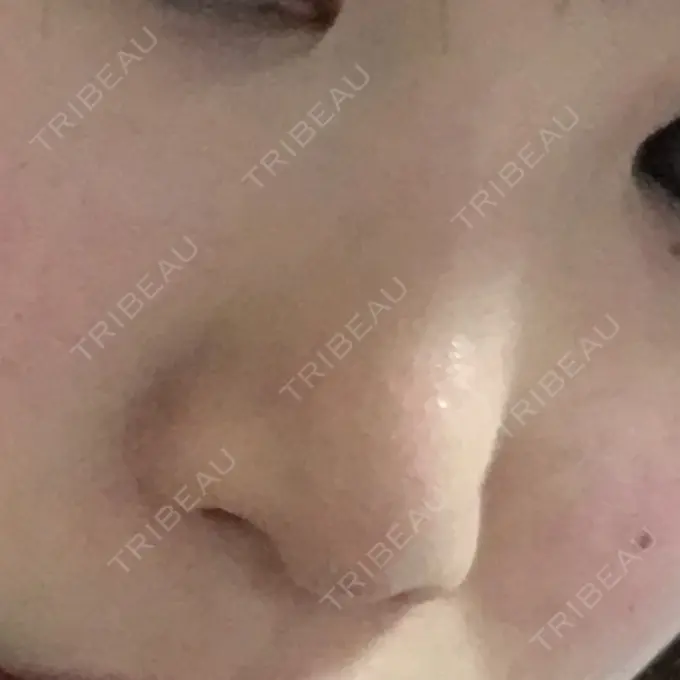 レディエッセ注入（鼻） 赤坂プレミアクリニック BEFORE メイン用