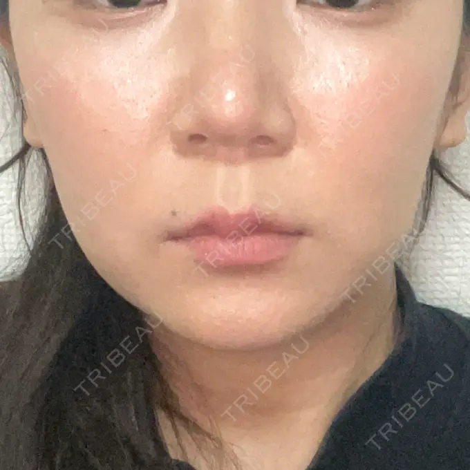 二重埋没 / 糸リフト / ヒアルロン酸注入（涙袋） / ボトックス（エラ・小顔） / ヒアルロン酸注入（頬） 東京シンデレラ美容外科 池袋院 BEFORE メイン用