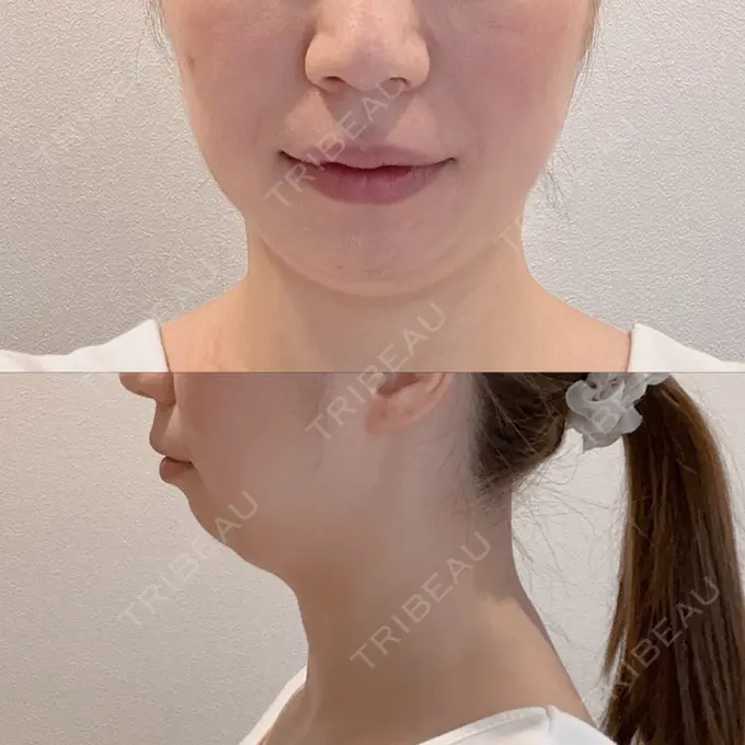 ルフォー+ssro（両あご) シェリークリニック 渋谷院 BEFORE メイン用