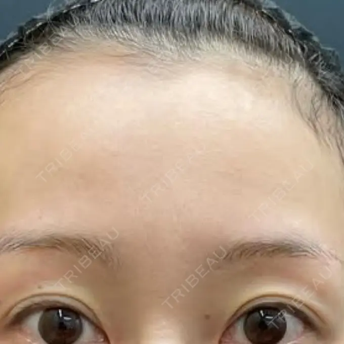 アートメイク（眉） しんゆり美容健康クリニック BEFORE メイン用