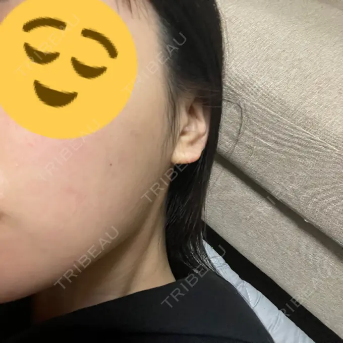 ボトックス（あご） / ボトックス（エラ・小顔） TCB東京中央美容外科 宇都宮院 BEFORE メイン用