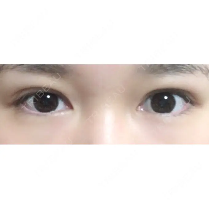 二重切開 / 上まぶたの脂肪取り / その他（目元） 湘南美容クリニック 新宿本院 BEFORE メイン用