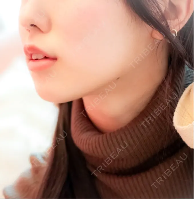 ヒアルロン酸注入（あご） / ヒアルロン酸注入（唇） / ヒアルロン酸注入（額） / ヒアルロン酸注入（頬） / ヒアルロン酸注入（鼻翼基部） シェリークリニック 渋谷院 BEFORE メイン用