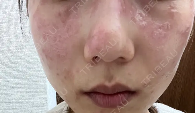 ピコスポット 東京シルククリニック 新宿院 BEFORE メイン用