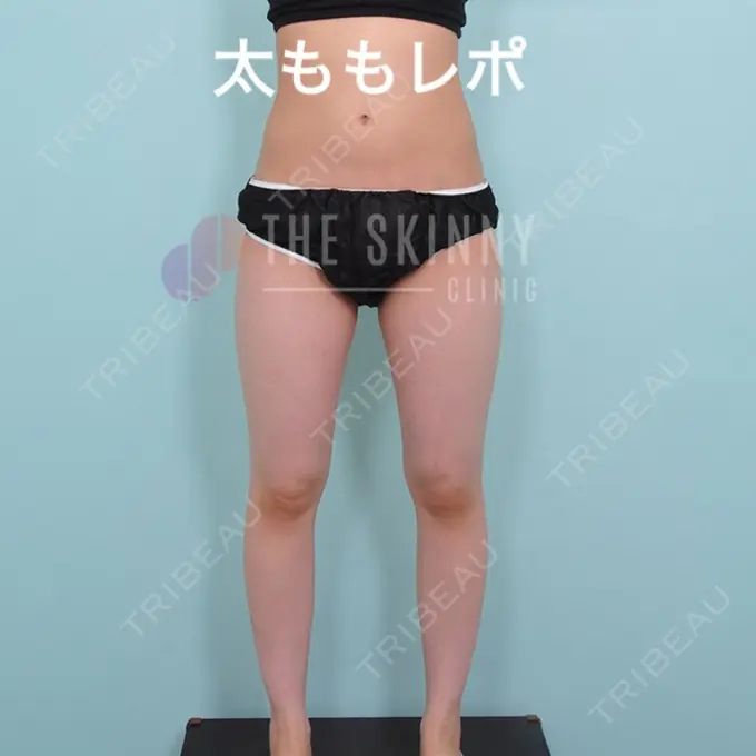 ボトックス（ふくらはぎ） / 脂肪溶解注射 / 脂肪溶解注射（太もも） / その他（ボディ） THE SKINNY CLINIC（ザ・スキニークリニック） BEFORE メイン用