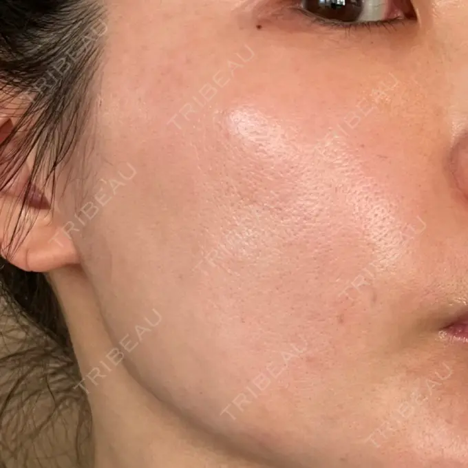 ルメッカ 大美会クリニック 心斎橋本院 BEFORE メイン用