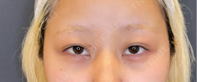 目尻切開 / タレ目形成・グラマラスライン（埋没） / ボトックス（エラ・小顔） LOUIS CLINIC 二子玉川院【ルイクリニック】 BEFORE メイン用