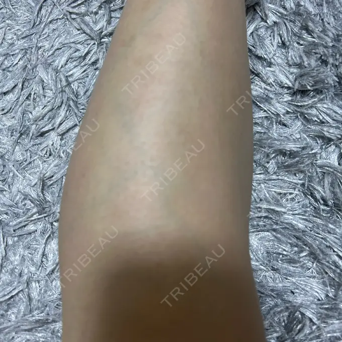 医療脱毛（脚） プライベートスキンクリニック 梅田本院 BEFORE メイン用