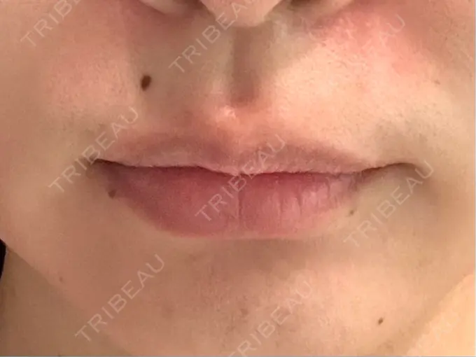 ボトックス（エラ・小顔） / ボトックス（口角） / ボトックス（人中） ルヴィクリニック イオンドーム前院 BEFORE メイン用