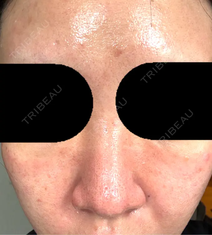 ヴェルヴェットスキン おおたかの森ビューティークリニック BEFORE メイン用