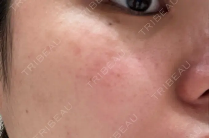 ピコスポット アマリラビューティークリニック BEFORE メイン用