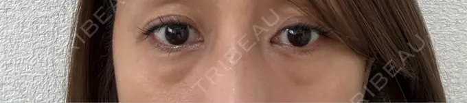 クマ治療 / 下まぶたの脂肪取り / ヒアルロン酸注入（目の下） / その他（目元） ROOTS Clinic BEFORE メイン用