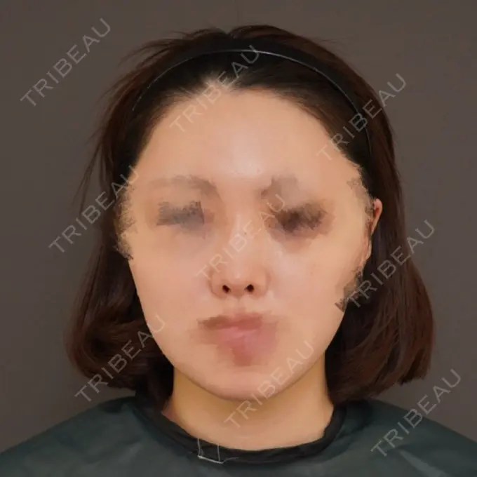 隆鼻術 / 鼻尖形成（切開） / 鼻中隔延長（切開） / 軟骨移植 / 鼻孔縁挙上 / 鼻孔縁下降 / 鼻翼基部形成（貴族手術） / その他（鼻） Designo Clinic （デジーノクリニック） BEFORE メイン用