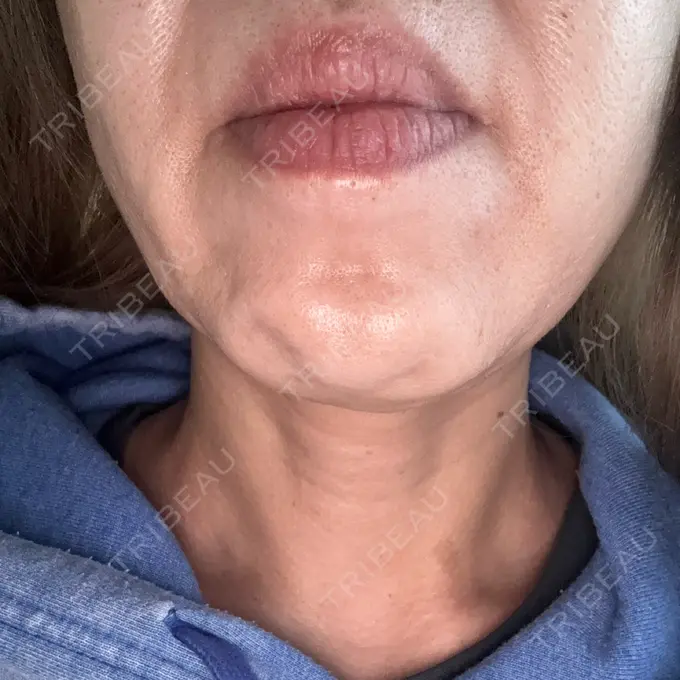 ボトックス（あご） Mavie Beauty Clinic （マヴィービューティークリニック） BEFORE メイン用