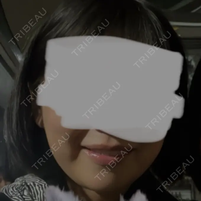 糸リフト / 脂肪吸引（顔） Otus Clinic 【オータスクリニック】 BEFORE メイン用