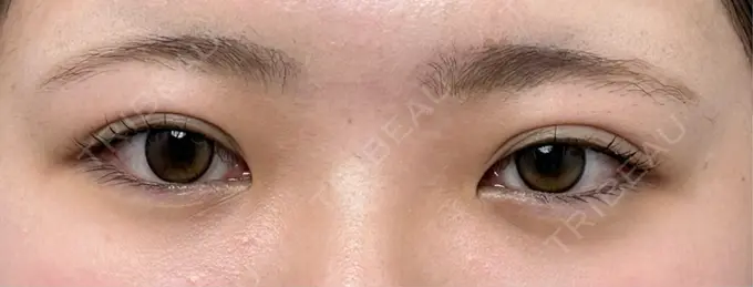 ヒアルロン酸注入（涙袋） / ヒアルロン酸注入（唇） 仙台N美容クリニック BEFORE メイン用