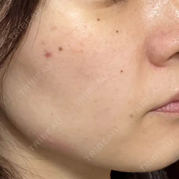 イオン導入 / 毛穴洗浄（ハイドラフェイシャルなど） / ルメッカ ルラ美容クリニック 大宮院 / ルラスキンクリニック 大宮院 BEFORE メイン用