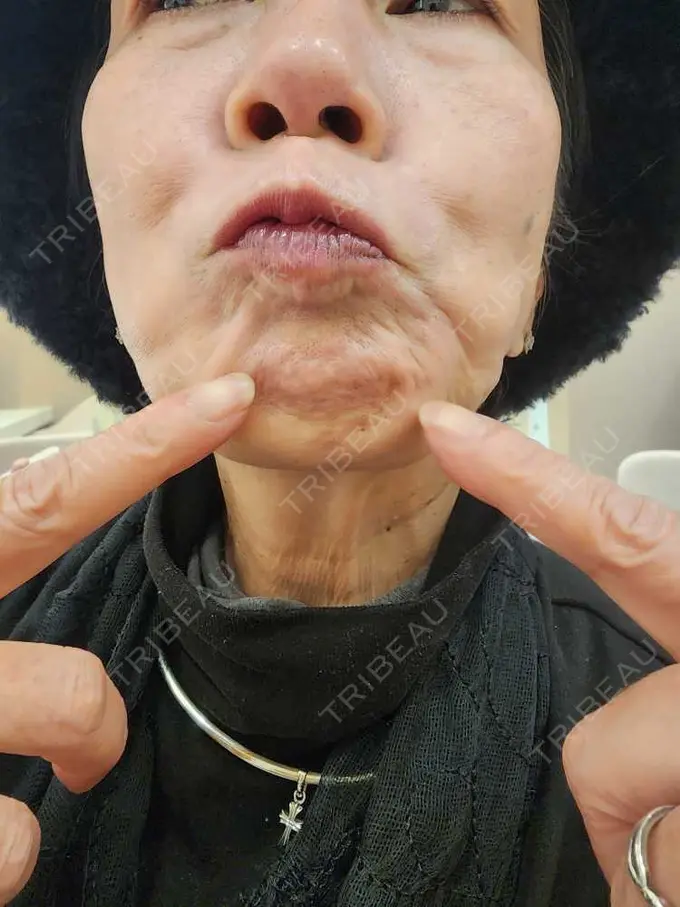 ボトックス（眉間） / ボトックス（目尻） ルラ美容クリニック 広島院 BEFORE メイン用