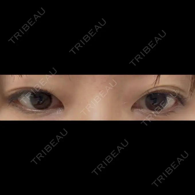 二重埋没 水の森美容クリニック 東京銀座院 BEFORE メイン用