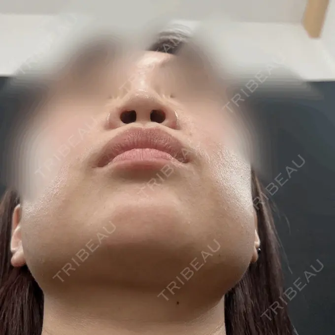 ヒアルロン酸注入（鼻） / ボトックス（あご） / ヒアルロン酸注入（目の下） / ヒアルロン酸注入（こめかみ） / ヒアルロン酸注入（鼻翼基部） / その他（鼻） THE FIRST CLINIC 町田院 BEFORE メイン用