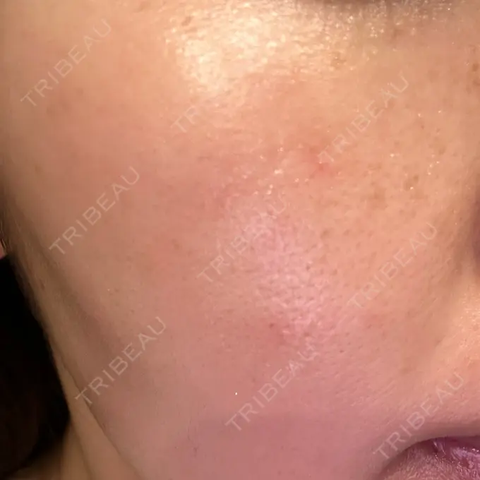 光治療（フォトフェイシャルなど） おおたかの森ビューティークリニック BEFORE メイン用