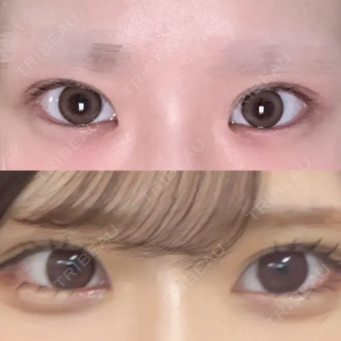 ヒアルロン酸注入（涙袋） フィラークリニック 渋谷院 BEFORE メイン用