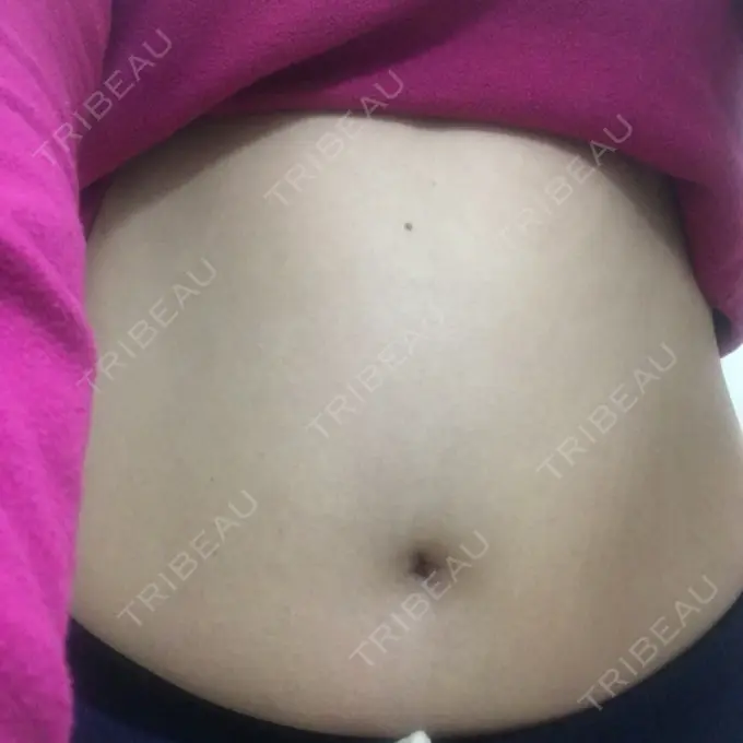 その他（ボディ） 品川美容外科 仙台院 BEFORE メイン用