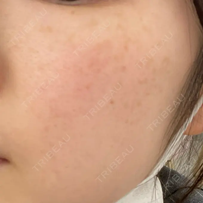 ルメッカ ルラ美容クリニック 大阪本院 BEFORE メイン用