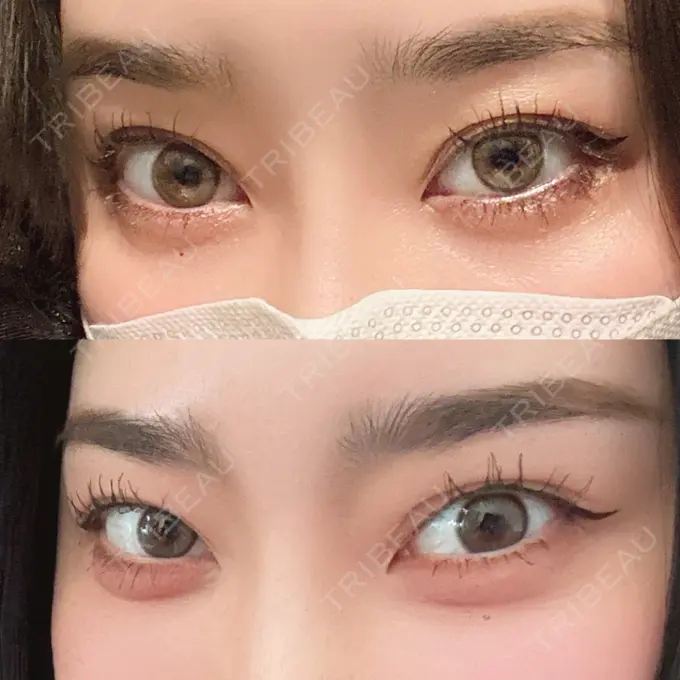 ヒアルロン酸注入（涙袋） / 肌育注射（ジュベルックなど） シェリークリニック 渋谷院 BEFORE メイン用