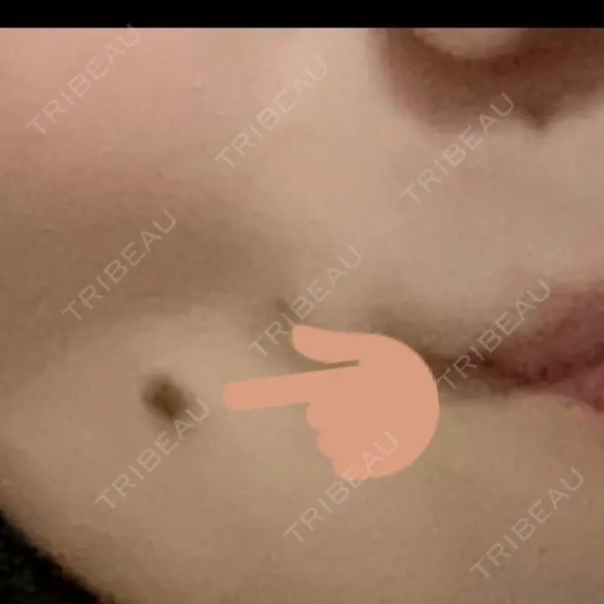 ほくろ・いぼ切除（肌） ルラ美容クリニック 広島院 BEFORE メイン用