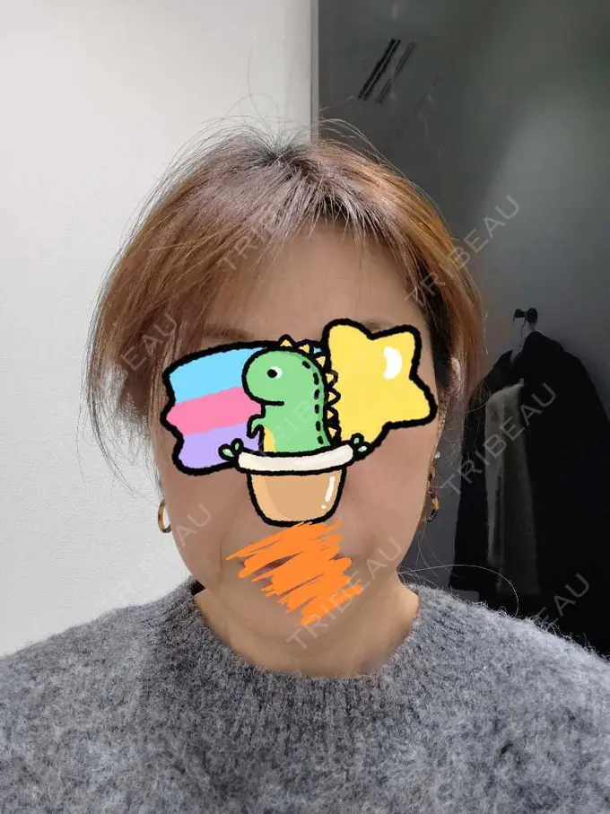 肌ヒアルロン酸注入（たるみ・シワ改善） / シワ取りボトックス TCB東京中央美容外科 越谷院 BEFORE メイン用