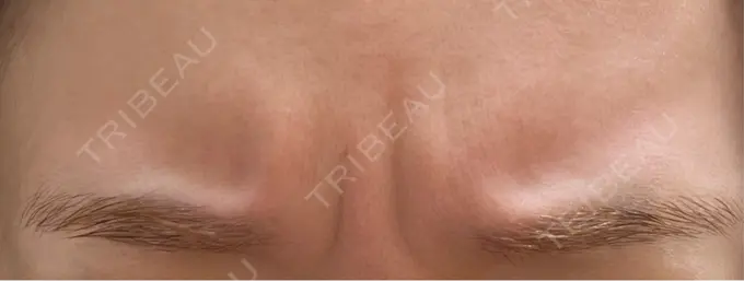 ボトックス（眉間） / ボトックス（額） ルラ美容クリニック 池袋院 BEFORE メイン用