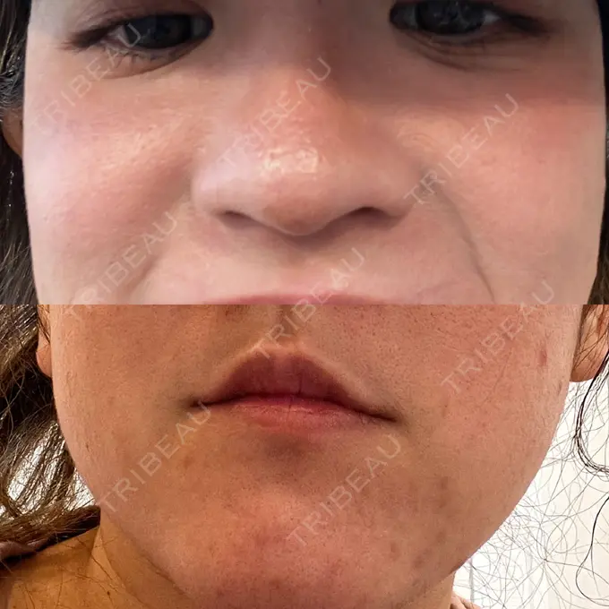 美肌レーザー / 美白レーザー / 光治療（フォトフェイシャルなど） / YAGレーザー / レーザーフェイシャル / 赤み除去レーザー AI Beauty Clinic （エーアイ美容クリニック） BEFORE メイン用