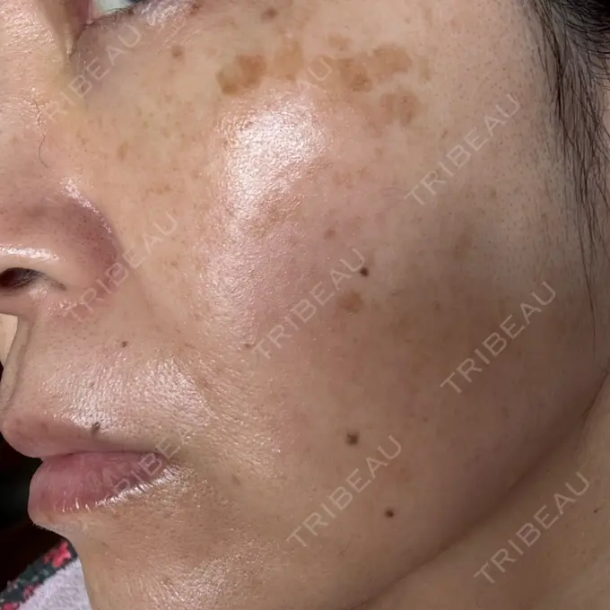 ピコレーザートーニング（美白・肝斑） / ピコフラクショナルレーザー（毛穴・ニキビ跡） ルラ美容クリニック 仙台院 / ルラスキンクリニック 仙台院 BEFORE メイン用