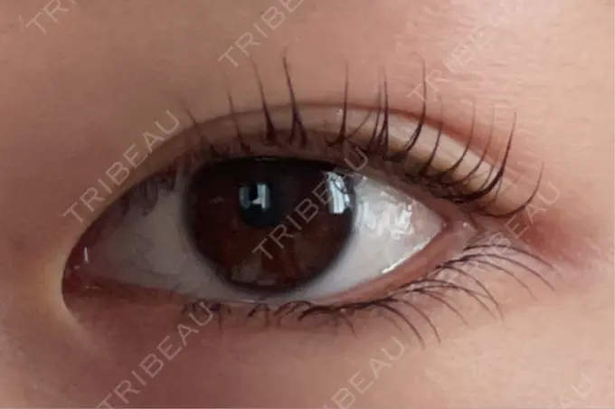 目頭切開 東京シンデレラ美容外科 池袋院 BEFORE メイン用