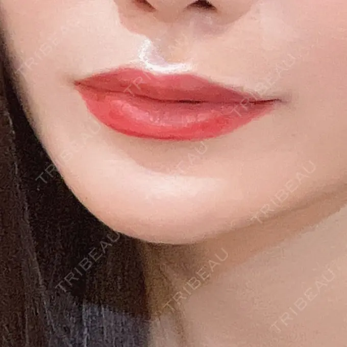 ヒアルロン酸注入（涙袋） / ボトックス（エラ・小顔） / ヒアルロン酸注入（唇） 東京シンデレラ美容外科 池袋院 BEFORE メイン用