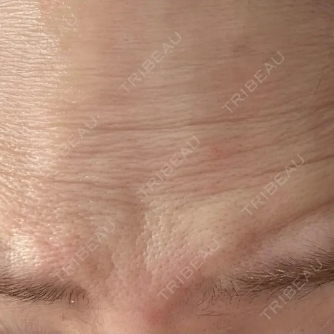 ボトックス（目尻） / ボトックス（額） 湘南美容クリニック 大阪梅田本院 BEFORE メイン用