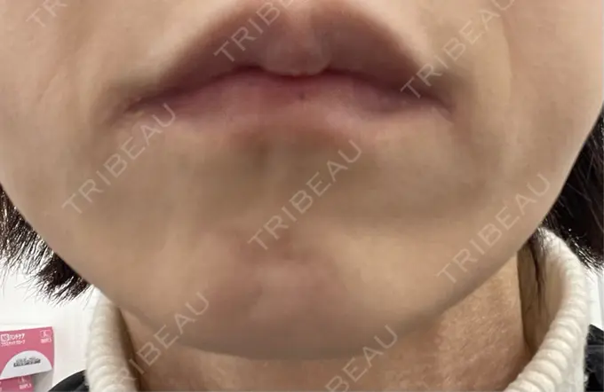 ボトックス（あご） TCB東京中央美容外科 神戸院 BEFORE メイン用