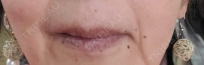 ヒアルロン酸注入（唇） / ボトックス（口角） ルラ美容クリニック 広島院 BEFORE メイン用