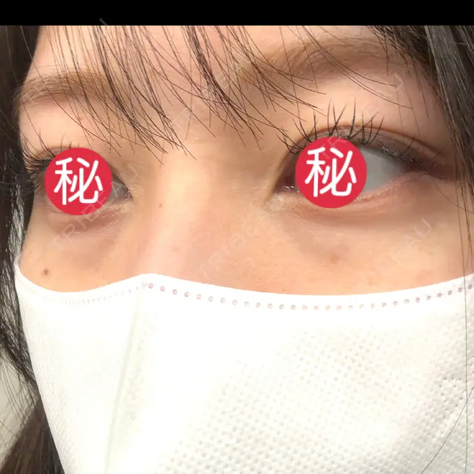 クマ治療 BIOTOPE CLINIC 【ビオトープクリニック】 BEFORE メイン用