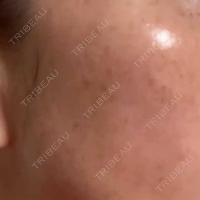 ルメッカ ルラ美容クリニック 広島院 BEFORE メイン用