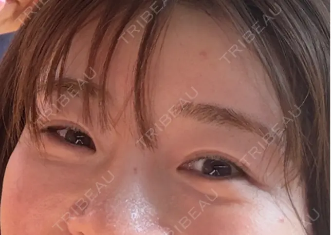 肌育注射（ジュベルックなど） APスキンクリニック銀座 BEFORE メイン用