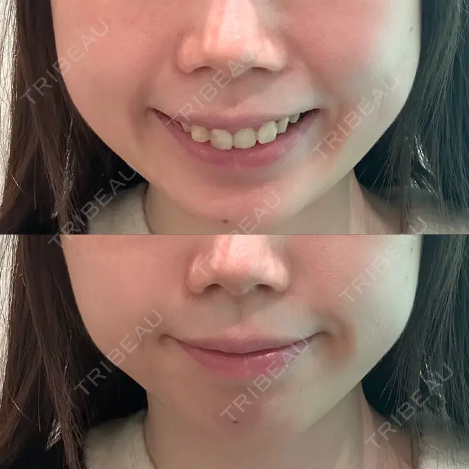 バッカルファット除去 / ボトックス（エラ・小顔） WOM CLINIC GINZA （ワム クリニック ギンザ） BEFORE メイン用