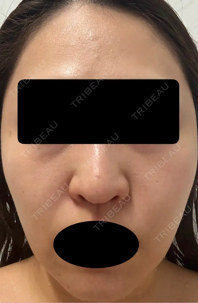 ピーリング（ハリ・ツヤ） VERDE CLINIC お茶の水（ベルデクリニックお茶の水） BEFORE メイン用