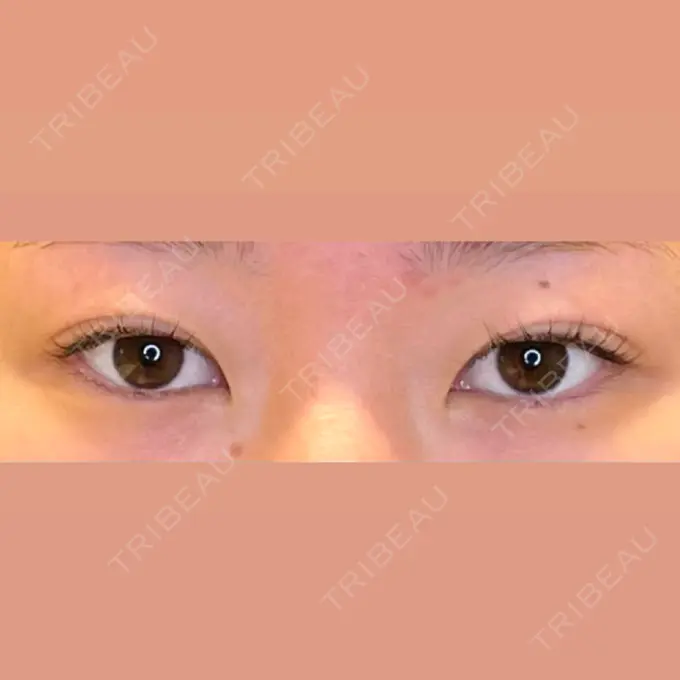 目尻切開 / タレ目形成・グラマラスライン（埋没） LOUIS CLINIC 二子玉川院【ルイクリニック】 BEFORE メイン用