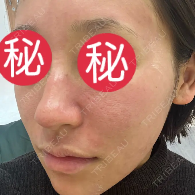 ポテンツァ REDLINE CLINIC BEFORE メイン用