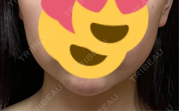 バッカルファット除去 湘南美容クリニック 博多院 BEFORE メイン用