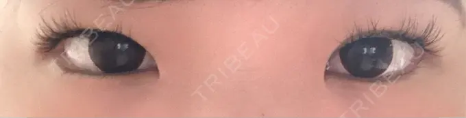 目頭切開 もとび美容外科クリニック 新宿院 BEFORE メイン用